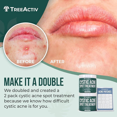 GloLAB Cystic Acne Patches - Professional Grade
